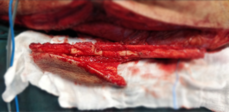 Jaw Bone Cancer